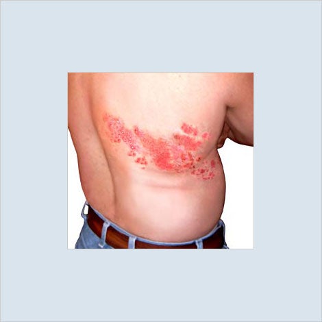 زونا: بیماری خفته، دشمن بیدار